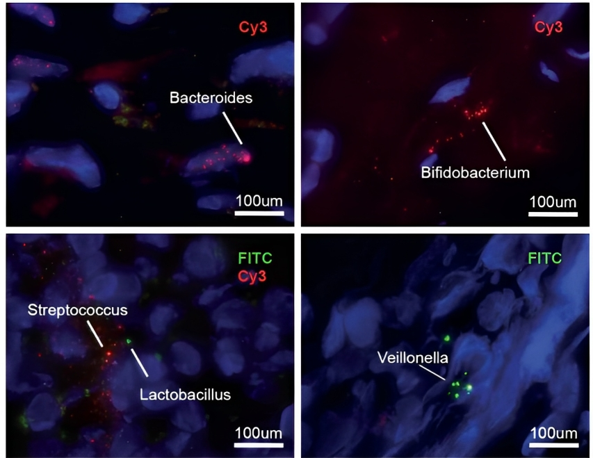 A Highly Specific Fecal Microbiota Signature for Pancreatic Cancer